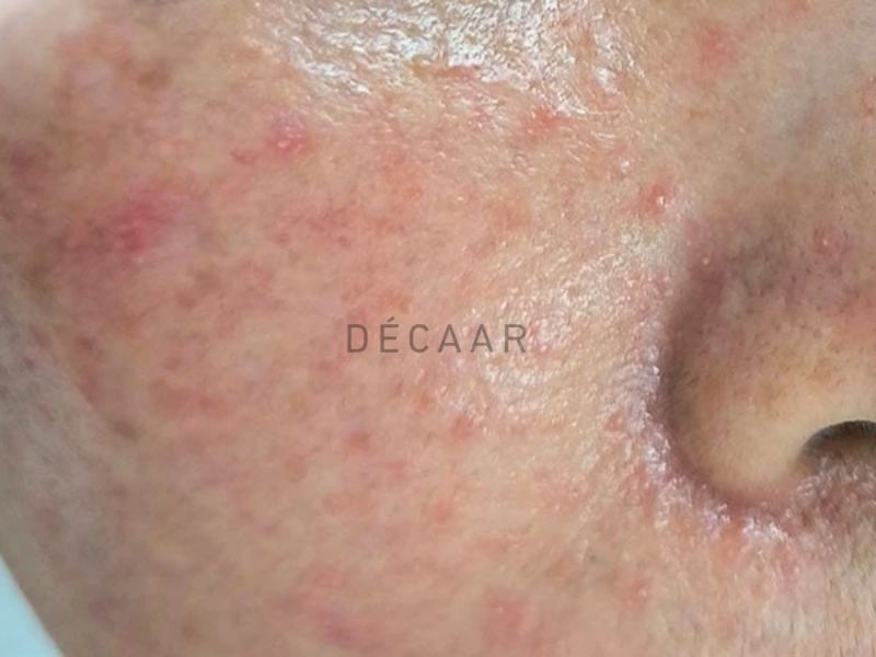 Lạm dụng peel da